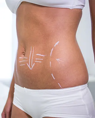 img-lipoescultura-con-marcacion-abdominal-en-bogota-1-LCP